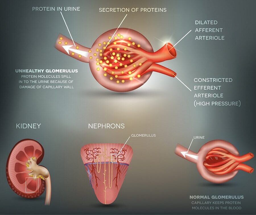 What Are the Signs of Diabetic Kidney Disease?